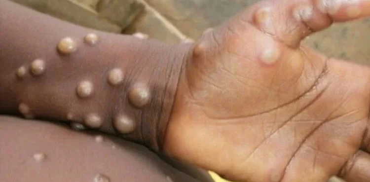 Four of seven child deaths in Khairpur linked to monkeypox, officials confirm